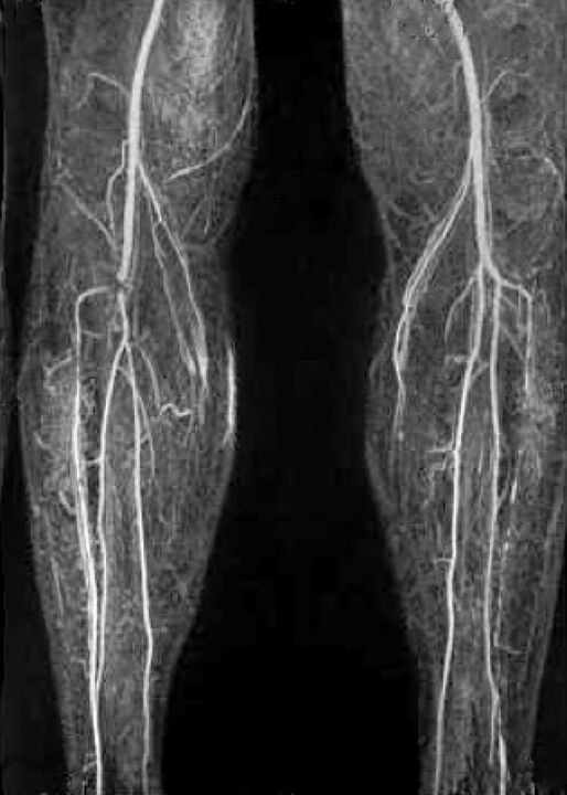 Gefäß X -RAY