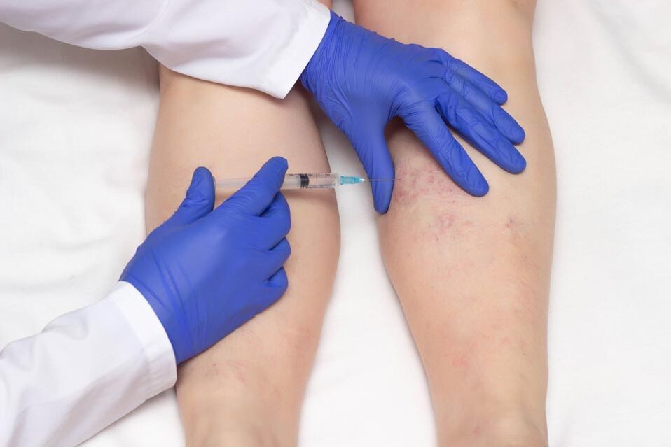 Die Sklerotherapie ist eine Methode zur Behandlung von Krampfadern