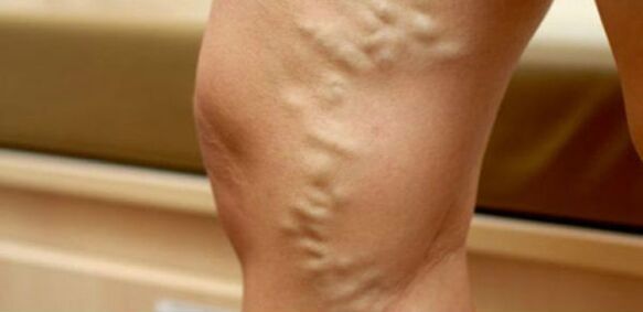 Krampfadern an den Beinen von Frauen
