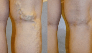 Anzeichen und Symptome von Krampfadern an den Beinen bei Männern