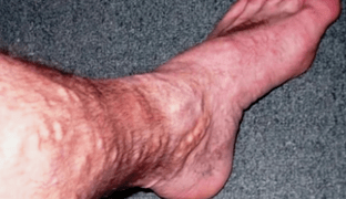 Ursachen von Krampfadern an den Beinen bei Männern