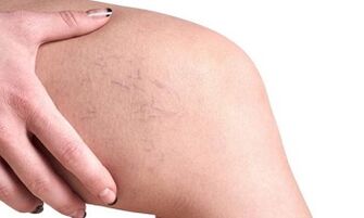 Entwicklungsstadien von Krampfadern