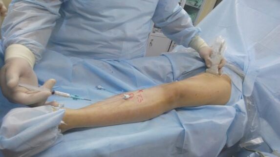 Operation bei Krampfadern an den Beinen
