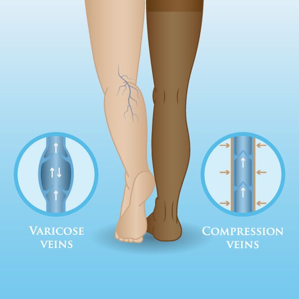 Auswirkungen von Kompressionswäsche auf Krampfadern in den Beinen