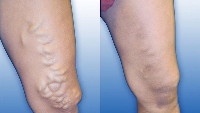 Beine vor und nach der Behandlung schwerer Krampfadern