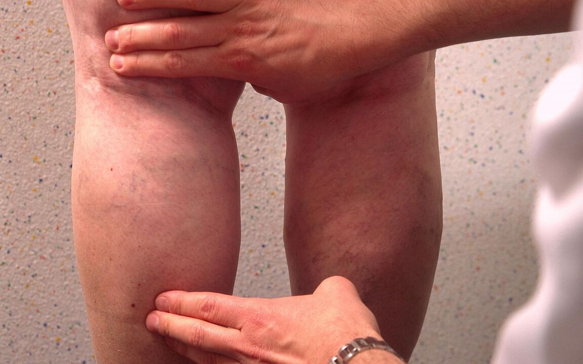 der Arzt untersucht die Beine mit Krampfadern