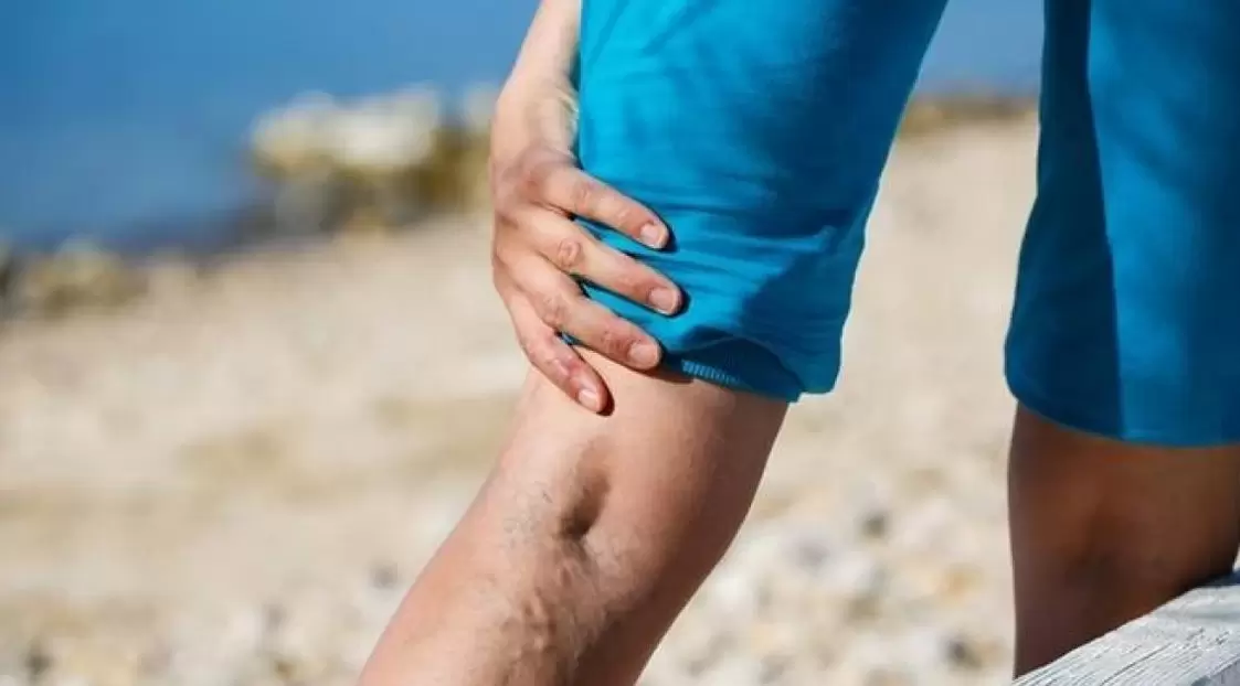 Hervortretende blaue Venen an den Beinen sind ein Zeichen für Krampfadern